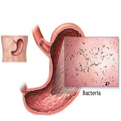 Cúm dạ dày - Hình ảnh minh họa